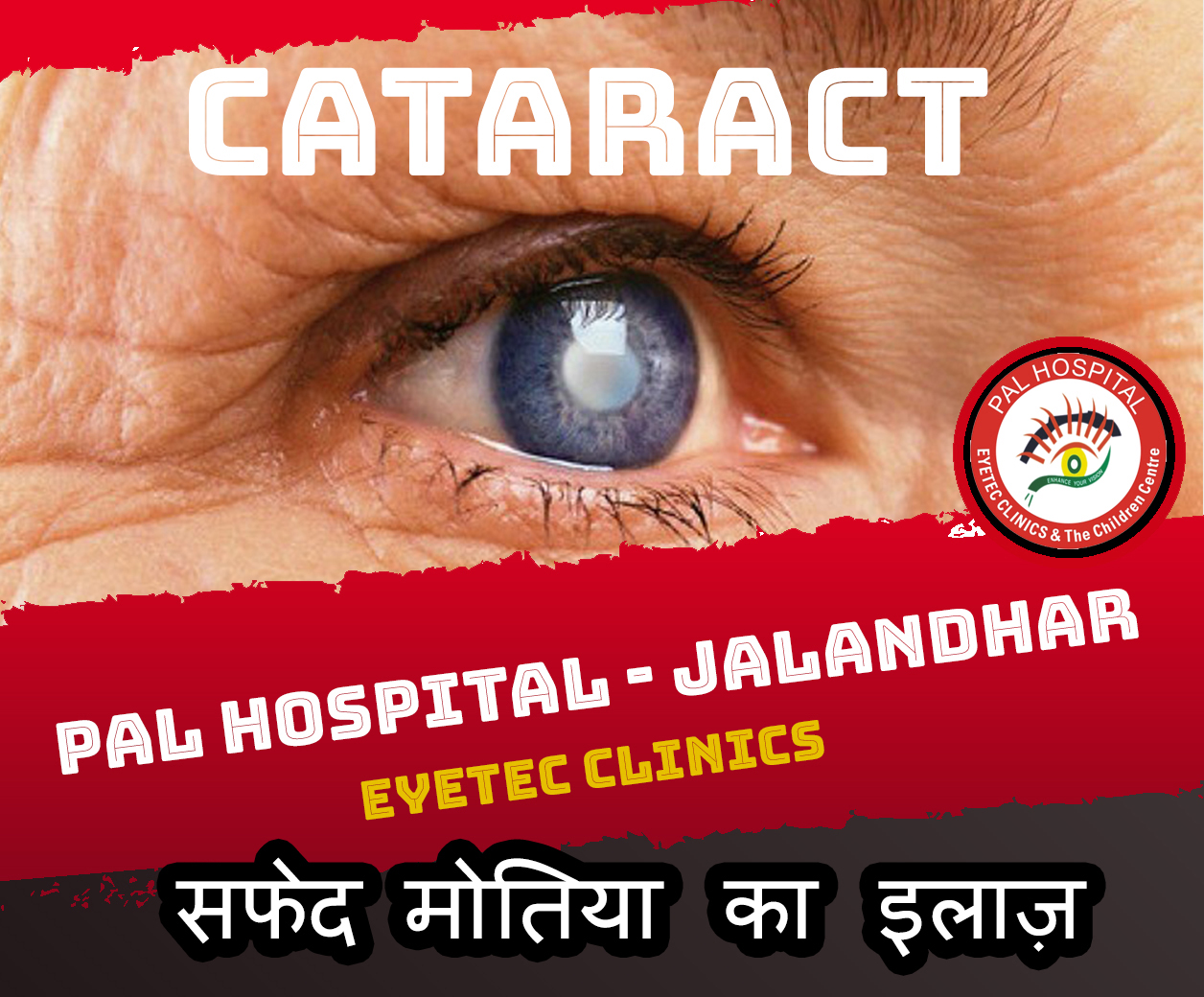 Cataract Surgery in Jalandhar | Pal Hospital Eyetec Clinics & The Children Centre