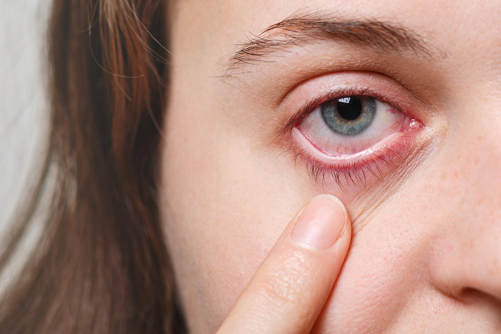 Dry Eye Disease | Red Eye | Pal Hospital Eyetec Clinics & The Children Centre