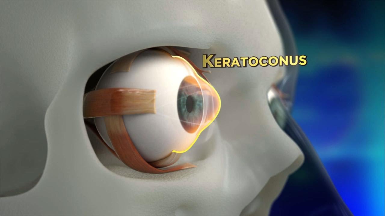 Keratoconus Treatment in Jalandhar