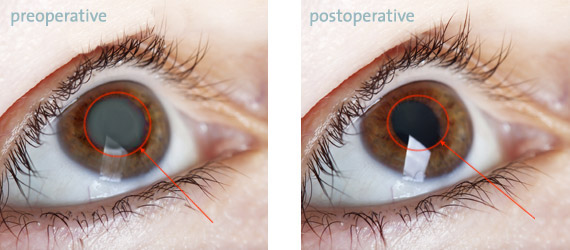 Cataract Surgery In Jalandhar | Pre Operative cataract eye - Post Operative Cataract Eye