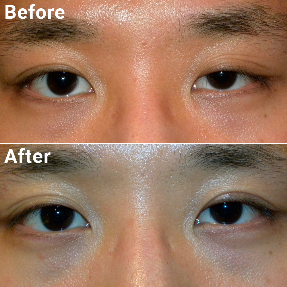 Ptosis Treatment at Pal Hospital Eyetec Clinics & The Children Centre